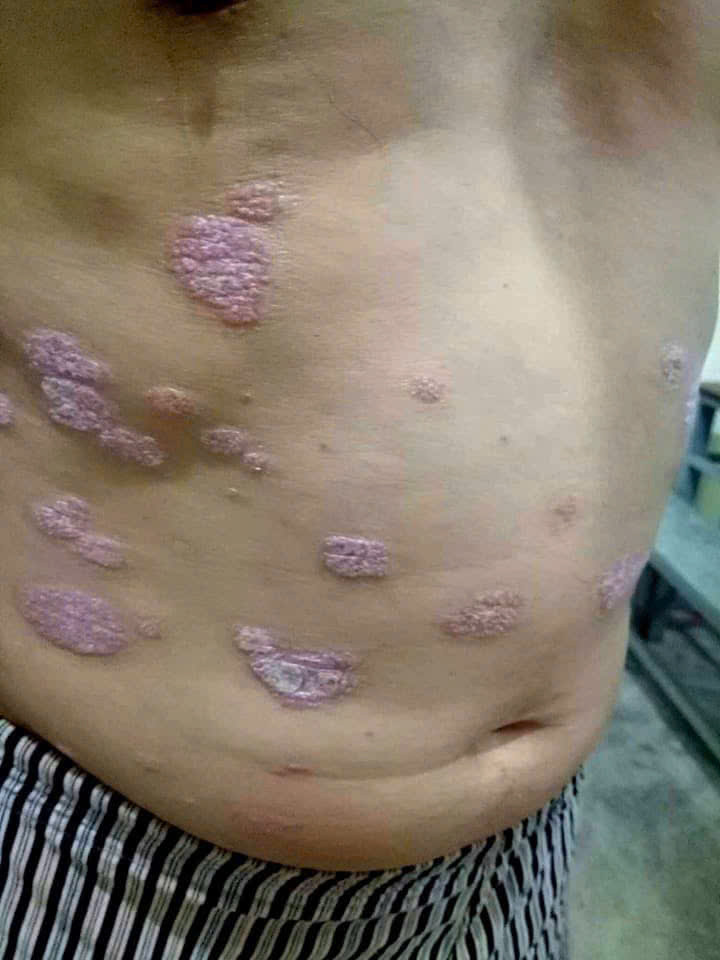 Vảy nến mảng (vùng bụng) – Anh M. – trước