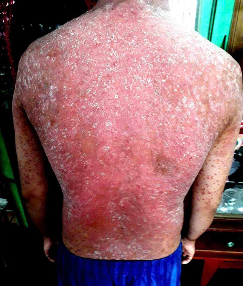 Vảy nến vùng lưng – Anh D. – trước