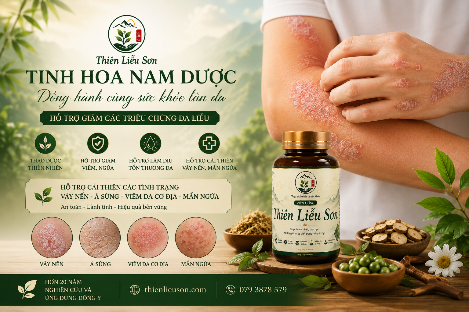 Thiên Liễu Sơn – hỗ trợ giảm triệu chứng vảy nến, á sừng, viêm da cơ địa, mẩn ngứa