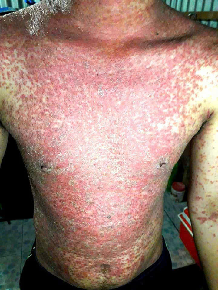 Vảy nến diện rộng (vùng ngực) – Anh H. – trước