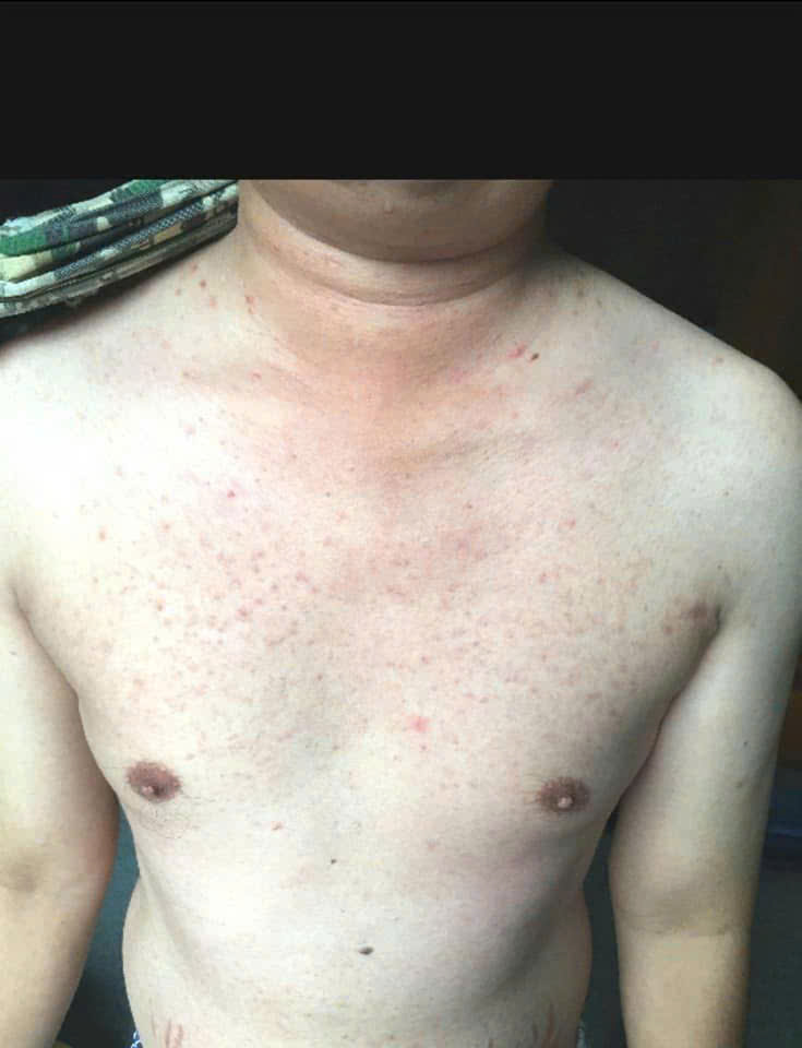 Vảy nến diện rộng (vùng ngực) – Anh H. – sau